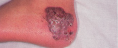 Granulomatous plaque of cutaneous aspergillosis on the left foot of a 13-year-old patient with Chronic Granulomatous Disease (CGD).