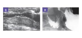 Imaging of gastric outlet obstruction in a 9-year-old boy with Chronic Granulomatous Disease