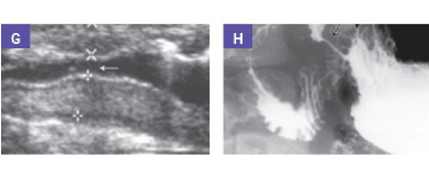 Imaging of gastric outlet obstruction in a 9-year-old boy with Chronic Granulomatous Disease