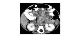 CT scan of a 2-month-old CGD patient showing intra-abdominal infection and protuberant abdomen