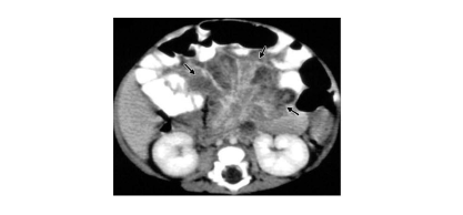 CT scan of a 2-month-old CGD patient showing intra-abdominal infection and protuberant abdomen