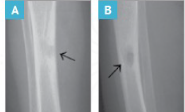 Side-by-side X-ray images showing early signs of osteomyelitis in a 4-year-old patient with Chronic Granulomatous Disease (CGD), with arrows pointing to the affected bone areas.