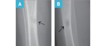 Side-by-side X-ray images showing early signs of osteomyelitis in a 4-year-old patient with Chronic Granulomatous Disease (CGD), with arrows pointing to the affected bone areas.