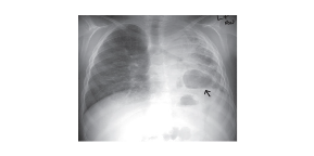 X-ray image showing pulmonary infection in an 8-year-old patient with Chronic Granulomatous Disease (CGD), with an arrow indicating the area of infection.