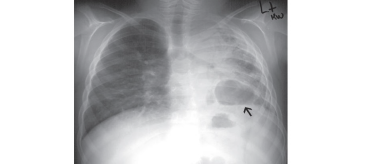 X-ray image showing pulmonary infection in an 8-year-old patient with Chronic Granulomatous Disease (CGD), with an arrow indicating the area of infection.