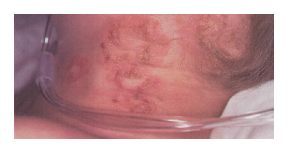 Vesicular lesions on the neck of an 8-year-old boy with X-linked Chronic Granulomatous Disease (CGD), measuring 2 to 3 mm