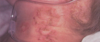 Vesicular lesions on the neck of an 8-year-old boy with X-linked Chronic Granulomatous Disease (CGD), measuring 2 to 3 mm